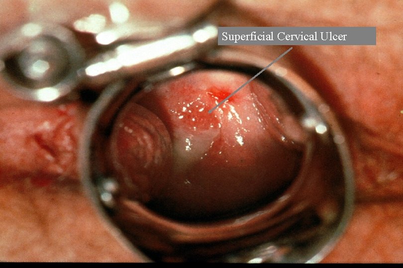Superficial Cervical Ulcer 