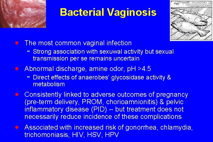 Bacterial Vaginosis · The most common vaginal infection - Strong association with sexuwal activity