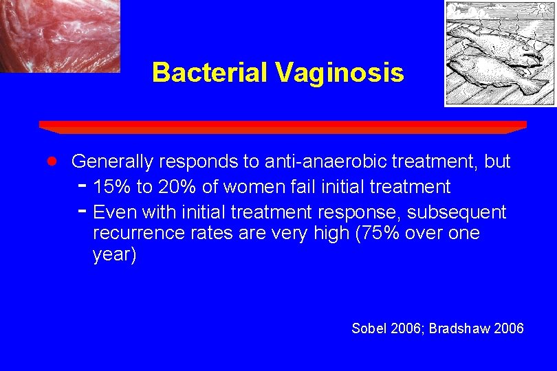 Bacterial Vaginosis · Generally responds to anti-anaerobic treatment, but - 15% to 20% of