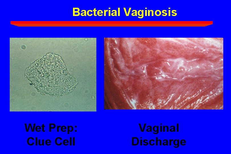 Bacterial Vaginosis Wet Prep: Clue Cell Vaginal Discharge 