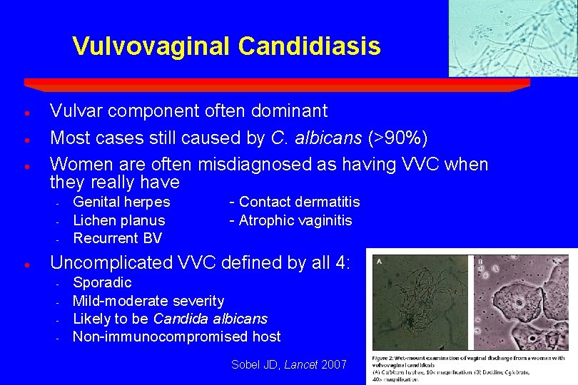 Vulvovaginal Candidiasis · · · Vulvar component often dominant Most cases still caused by