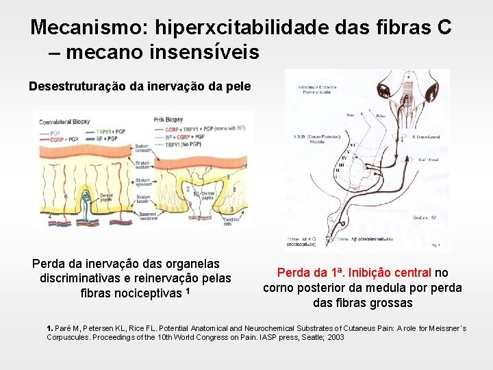 Mecanismo: hiperxcitabilidade das fibras C – mecano insensíveis Desestruturação da inervação da pele Perda