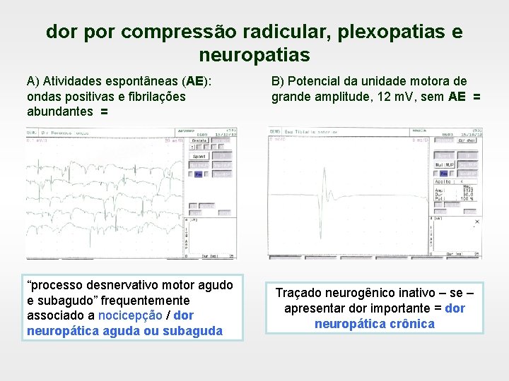 dor por compressão radicular, plexopatias e neuropatias A) Atividades espontâneas (AE): ondas positivas e