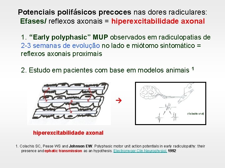 Potenciais polifásicos precoces nas dores radiculares: Efases/ reflexos axonais = hiperexcitabilidade axonal 1. “Early