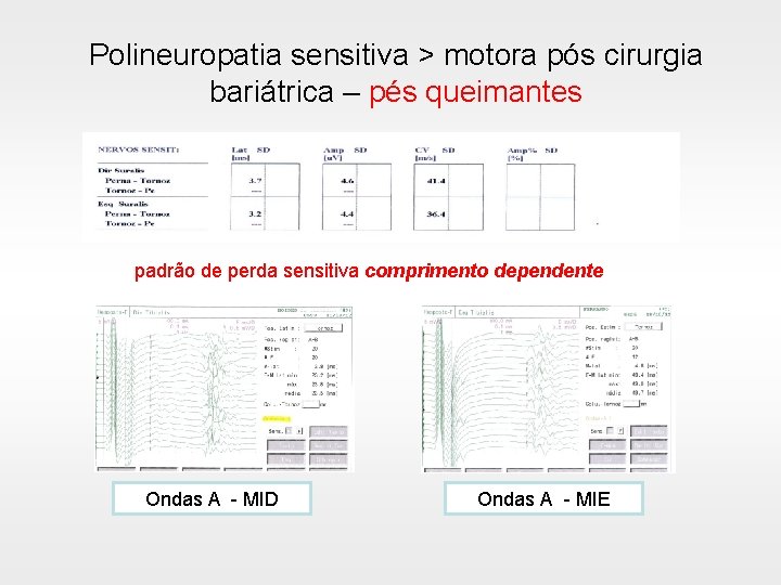 Polineuropatia sensitiva > motora pós cirurgia bariátrica – pés queimantes padrão de perda sensitiva