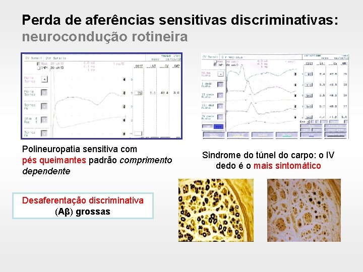 Perda de aferências sensitivas discriminativas: neurocondução rotineira Polineuropatia sensitiva com pés queimantes padrão comprimento