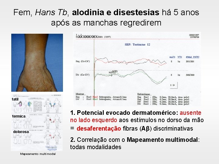 Fem, Hans Tb, alodinia e disestesias há 5 anos após as manchas regredirem xxxx