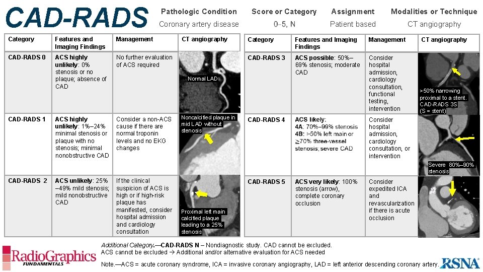 CAD-RADS Pathologic Condition Coronary artery disease Category Features and Imaging Findings Management CAD-RADS 0