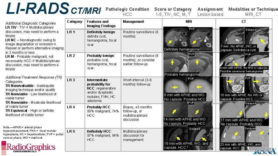 LI-RADS CT/MRI Additional Diagnostic Categories LR TIV - TIV Multidisciplinary discussion, may need to