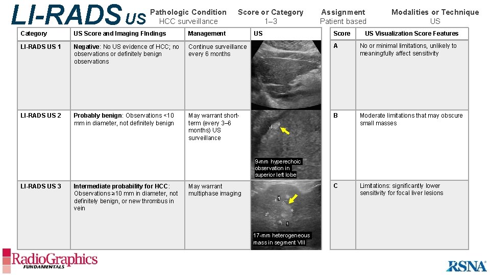 LI-RADS US Pathologic Condition HCC surveillance Score or Category 1– 3 US Assignment Patient
