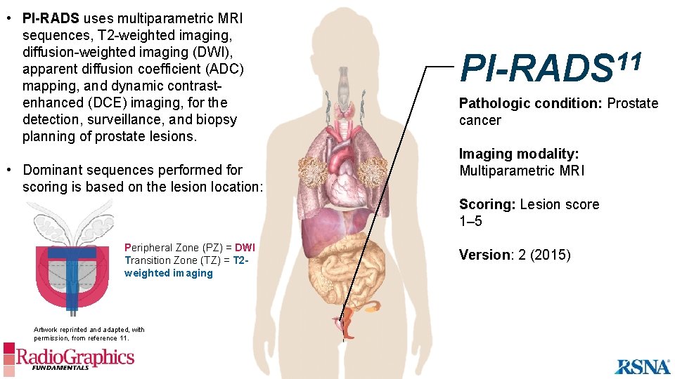  • PI-RADS uses multiparametric MRI sequences, T 2 -weighted imaging, diffusion-weighted imaging (DWI),