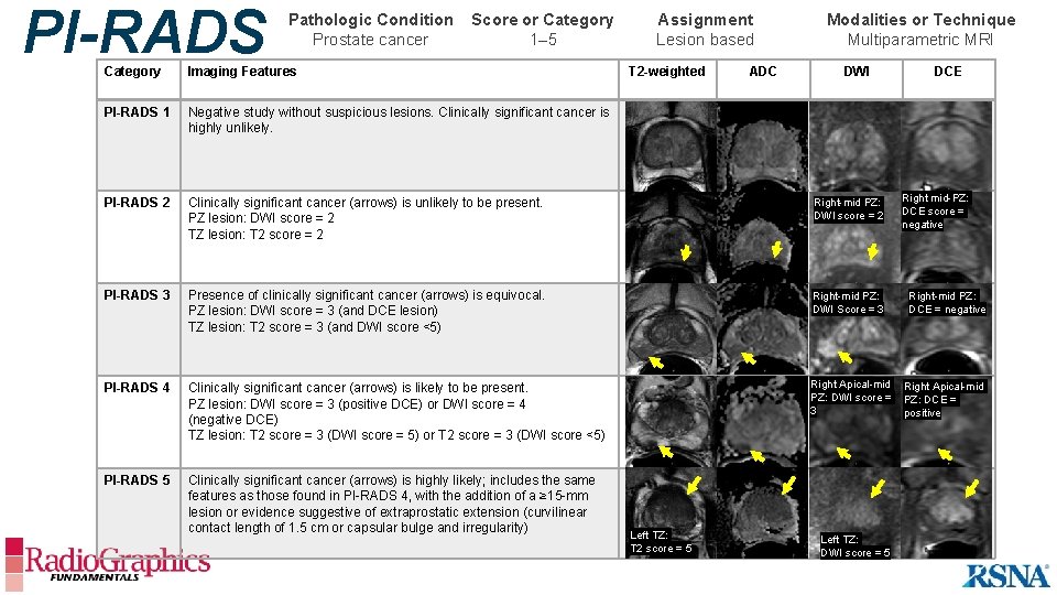PI-RADS Pathologic Condition Prostate cancer Score or Category 1– 5 Assignment Lesion based T