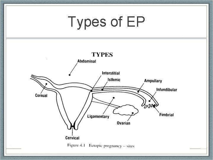 Types of EP 