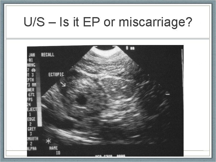 U/S – Is it EP or miscarriage? 