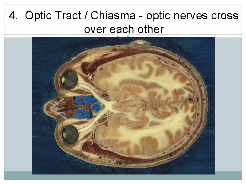 4. Optic Tract / Chiasma - optic nerves cross over each other 