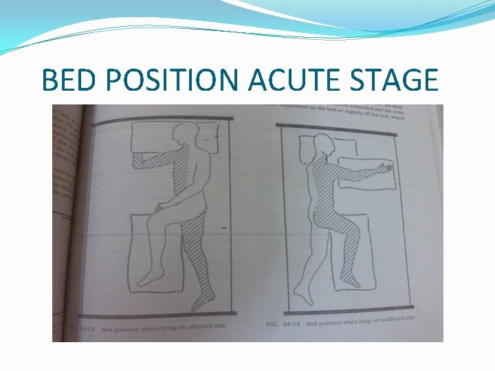 BED POSITION ACUTE STAGE 