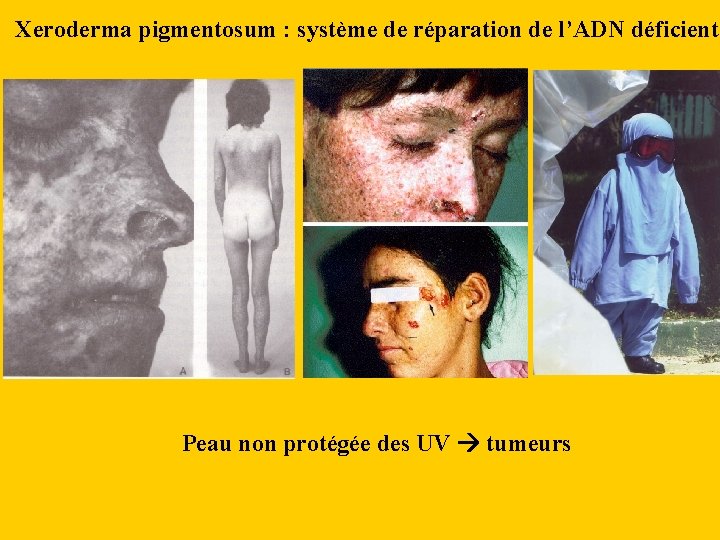 Xeroderma pigmentosum : système de réparation de l’ADN déficient Peau non protégée des UV