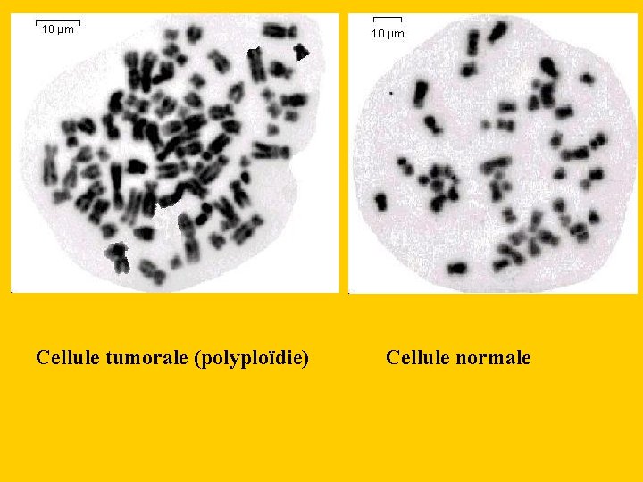 Cellule tumorale (polyploïdie) Cellule normale 