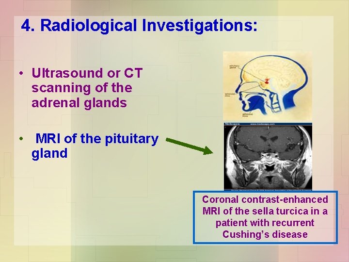 4. Radiological Investigations: • Ultrasound or CT scanning of the adrenal glands • MRI