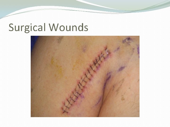 Surgical Wounds 