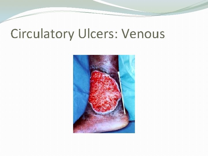 Circulatory Ulcers: Venous 