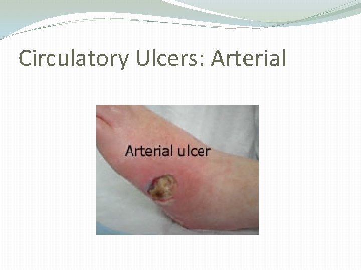 Circulatory Ulcers: Arterial 