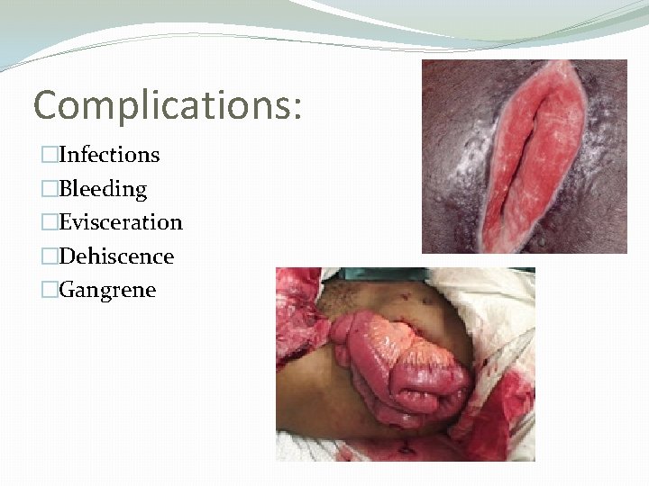 Complications: �Infections �Bleeding �Evisceration �Dehiscence �Gangrene 