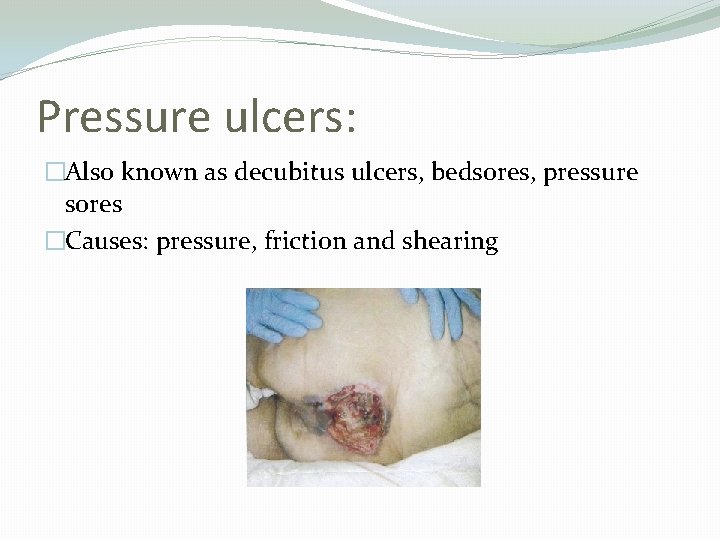 Pressure ulcers: �Also known as decubitus ulcers, bedsores, pressure sores �Causes: pressure, friction and