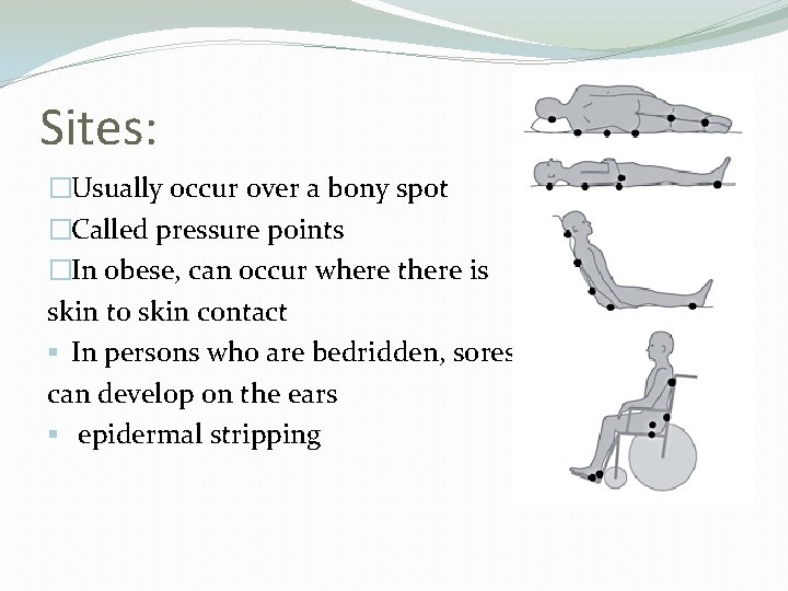 Sites: �Usually occur over a bony spot �Called pressure points �In obese, can occur