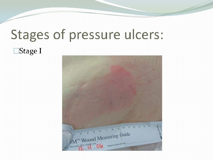 Stages of pressure ulcers: �Stage I 