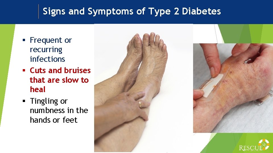 Signs and Symptoms of Type 2 Diabetes § Frequent or recurring infections § Cuts