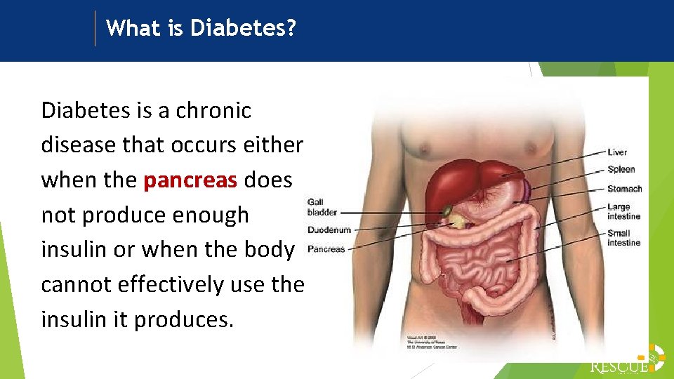 What is Diabetes? Diabetes is a chronic disease that occurs either when the pancreas