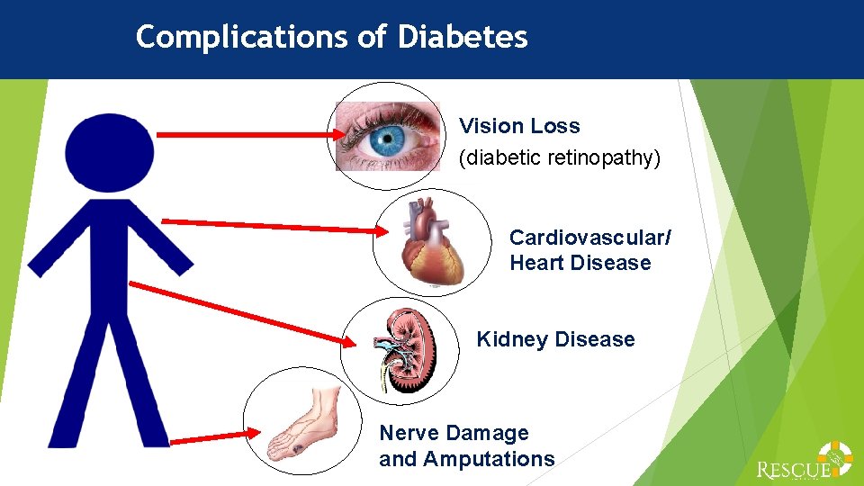 Complications of Diabetes Vision Loss (diabetic retinopathy) Cardiovascular/ Heart Disease Kidney Disease Nerve Damage