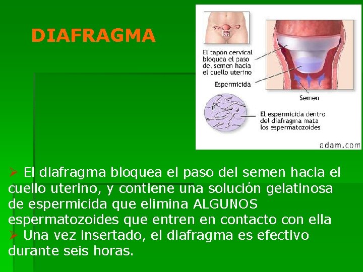 DIAFRAGMA Ø El diafragma bloquea el paso del semen hacia el cuello uterino, y