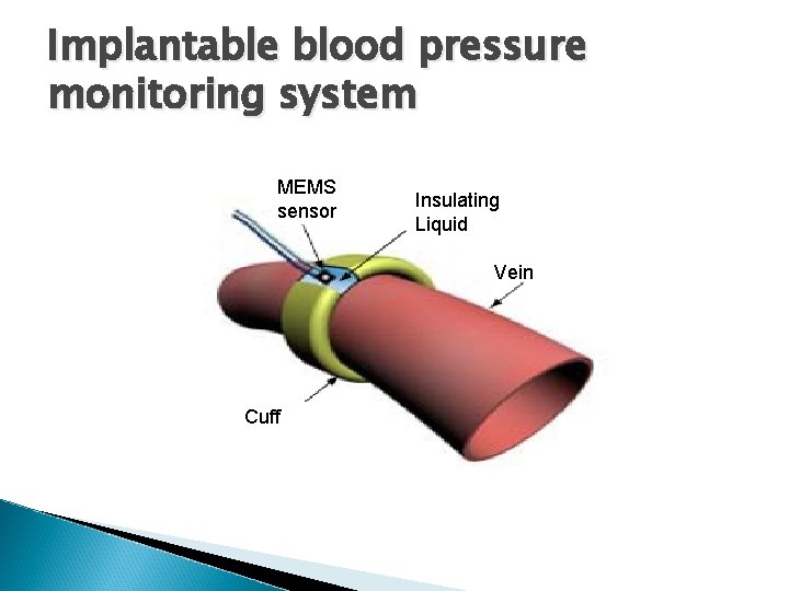 Implantable blood pressure monitoring system MEMS sensor Insulating Liquid Vein Cuff 