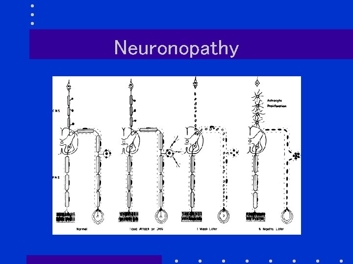 Neuronopathy 