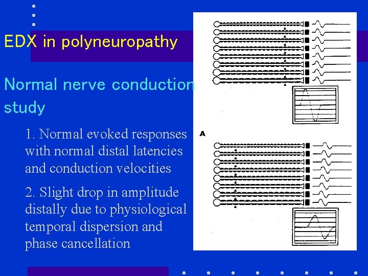 EDX in polyneuropathy Normal nerve conduction study 1. Normal evoked responses with normal distal