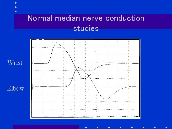 Normal median nerve conduction studies Wrist Elbow 