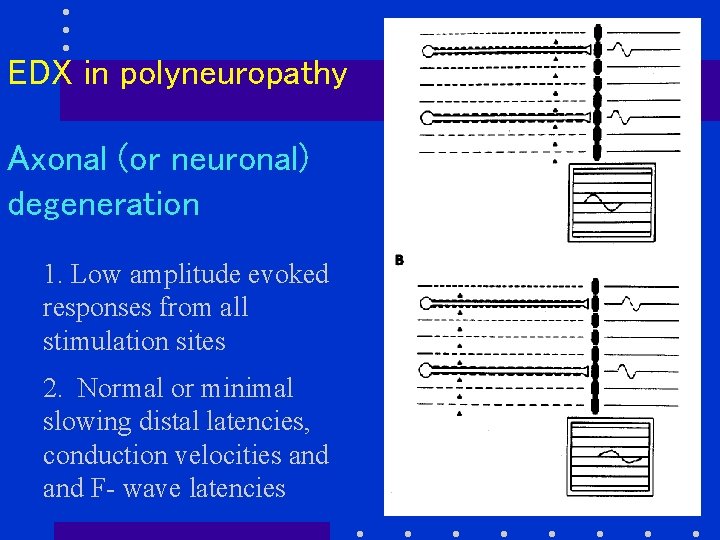EDX in polyneuropathy Axonal (or neuronal) degeneration 1. Low amplitude evoked responses from all