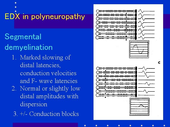 EDX in polyneuropathy Segmental demyelination 1. Marked slowing of distal latencies, conduction velocities and