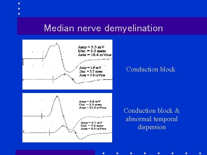 Median nerve demyelination Conduction block & abnormal temporal dispersion 