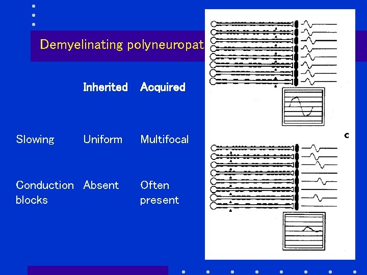 Demyelinating polyneuropathies Slowing Inherited Acquired Uniform Multifocal Conduction Absent blocks Often present 