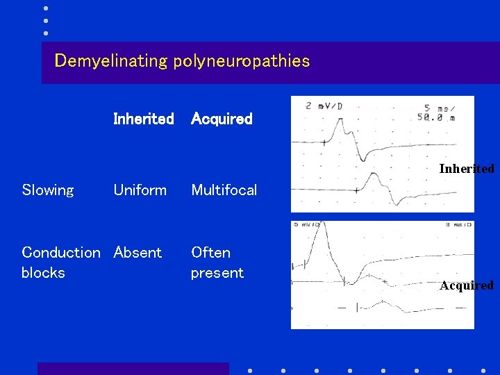 Demyelinating polyneuropathies Inherited Acquired Inherited Slowing Uniform Conduction Absent blocks Multifocal Often present Acquired