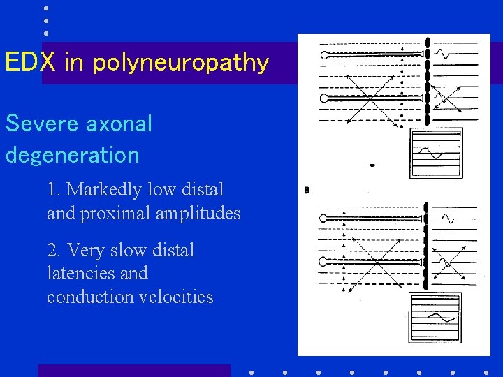 EDX in polyneuropathy Severe axonal degeneration 1. Markedly low distal and proximal amplitudes 2.