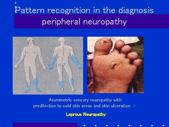 Pattern recognition in the diagnosis peripheral neuropathy Asymmetric sensory neuropathy with predilection to cold