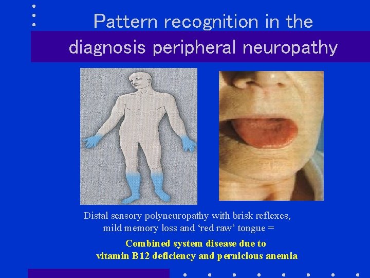 Pattern recognition in the diagnosis peripheral neuropathy Distal sensory polyneuropathy with brisk reflexes, mild