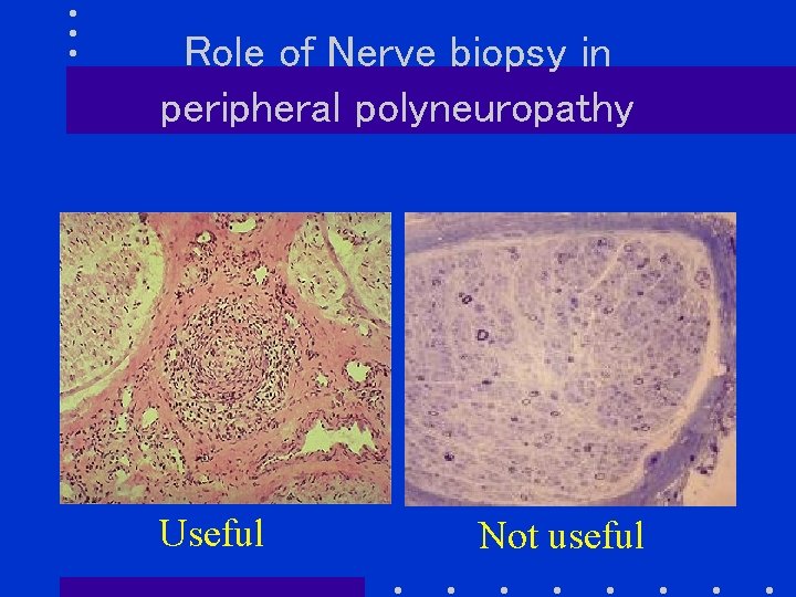 Role of Nerve biopsy in peripheral polyneuropathy Useful Not useful 