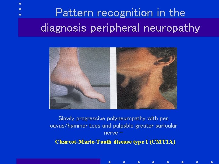 Pattern recognition in the diagnosis peripheral neuropathy Slowly progressive polyneuropathy with pes cavus/hammer toes