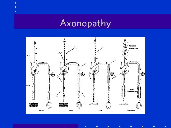 Axonopathy 