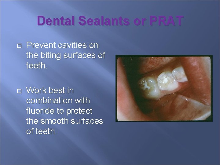 Dental Sealants or PRAT Prevent cavities on the biting surfaces of teeth. Work best